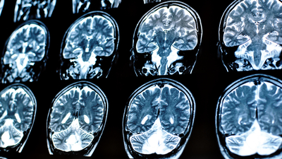 Uyku ilacı, Alzheimer ile ilişkili proteinlerin birikimini azaltabilir