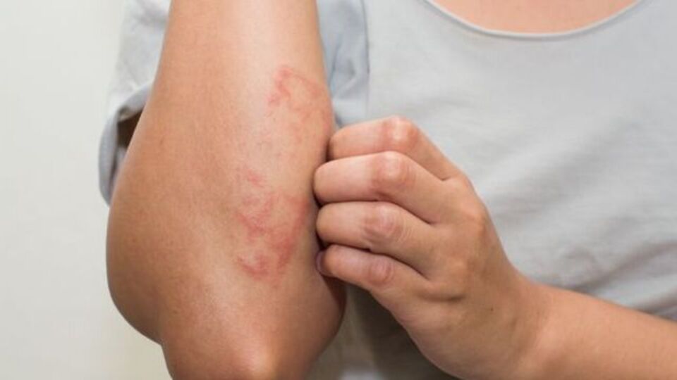 Sedef hastalığının diğer adı nedir?