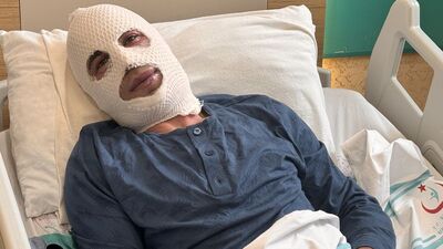 Ocakta ısıttığı sprey boya tüpü patladı