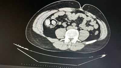 Midelerinde uyuşturucu çıkan 2 şüpheli tutuklandı