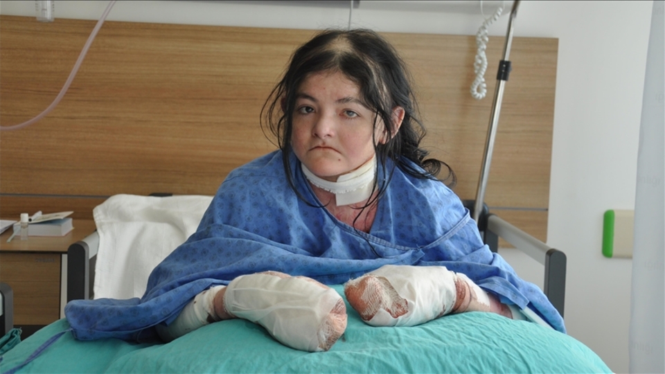 Parmakları bitişik ABD'li genç kız, şifayı Eskişehir'de buldu