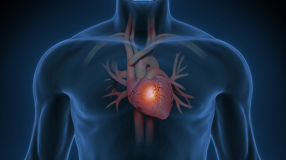 Aort yırtılması neden olur?