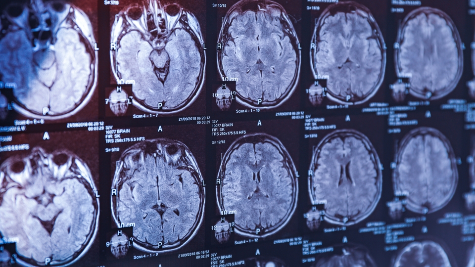 Şizofreni hastalarının beyinleri daha hızlı yaşlanabilir