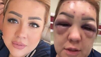 "Dayak değil, botoks"