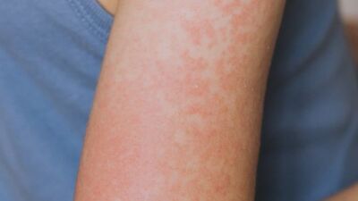 ABD'de kızamık salgını! Vaka sayısı 624'e yükseldi