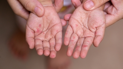 Japonya'da kızamık vakaları artıyor