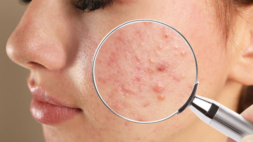 Zoretanin kilo aldırır mı?