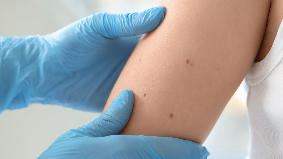 Vücutta görülen benlerde 'ABCDE' kuralına dikkat!