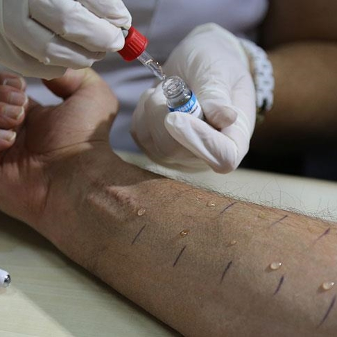 Türkiye'de toplumun yüzde 20'si alerjik belirtiler gösteriyor