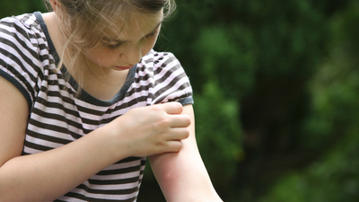 Sinek ısırıklarından doğal yollarla kurtulma yöntemleri