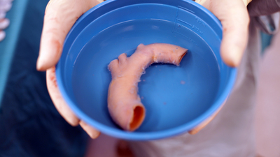 Kalbi 'yatay' doğdu, dünyada ikinci vaka!