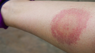 Keneye karşı "vücut kontrolü" uyarısı!