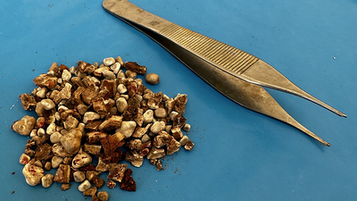 Hastanın iki böbreğinden 300'ün üzerinde taş çıktı