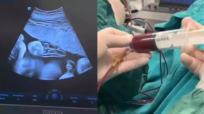 Anne karnındaki 8 aylık bebeğe kan nakli yapıldı