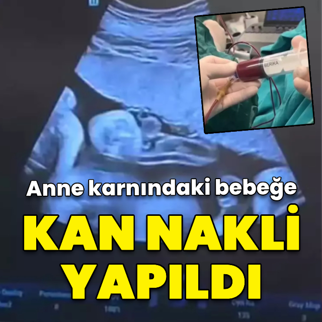 Anne karnındaki 8 aylık bebeğe kan nakli yapıldı