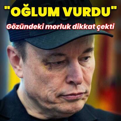 Elon Musk'ın gözündeki morluk dikkat çekti