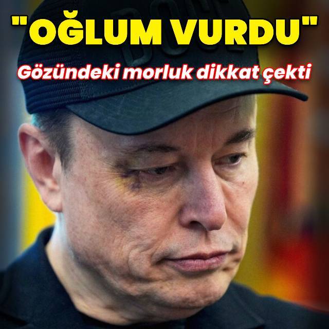 Elon Musk'ın gözündeki morluk dikkat çekti