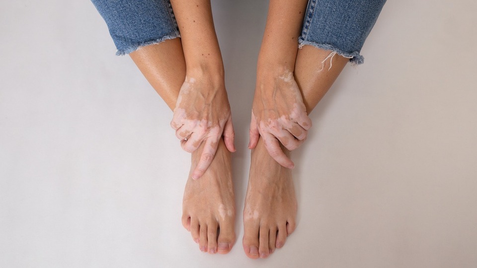 Vücutta beyaz lekeler neden olur?