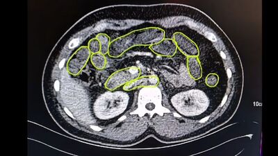 Mide ve bağırsaklarından uyuşturucu çıktı