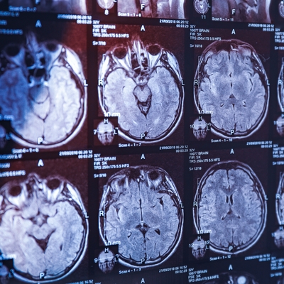 Alzheimer araştırmalarında riski artıran genetik varyant bulundu