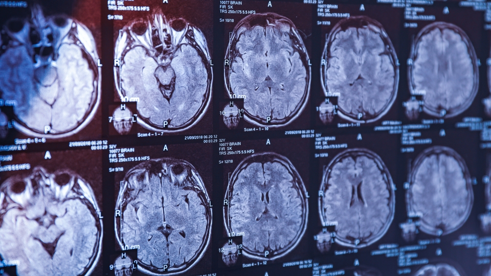 Alzheimer araştırmalarında riski artıran genetik varyant bulundu