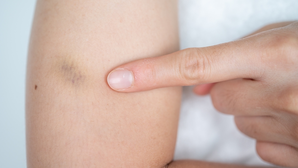 Kendiliğinden ortaya çıkan morluklara dikkat!