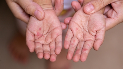 Çok hızlı yayılıyor! El, ayak ve ağız hastalığına dikkat!