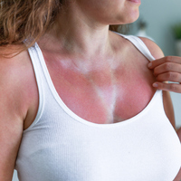 Güneş yanığına karşı etkili yöntemler!