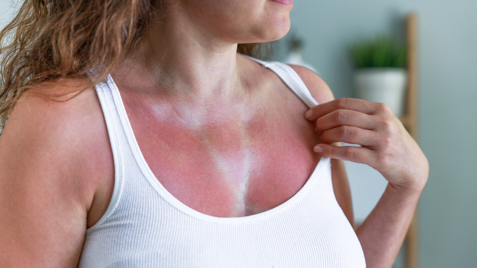 Güneş yanığına karşı etkili yöntemler!