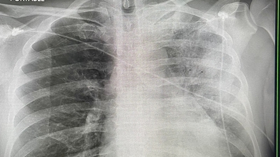 Klima hastalığına dikkat! Gecikmek ölüm getiriyor