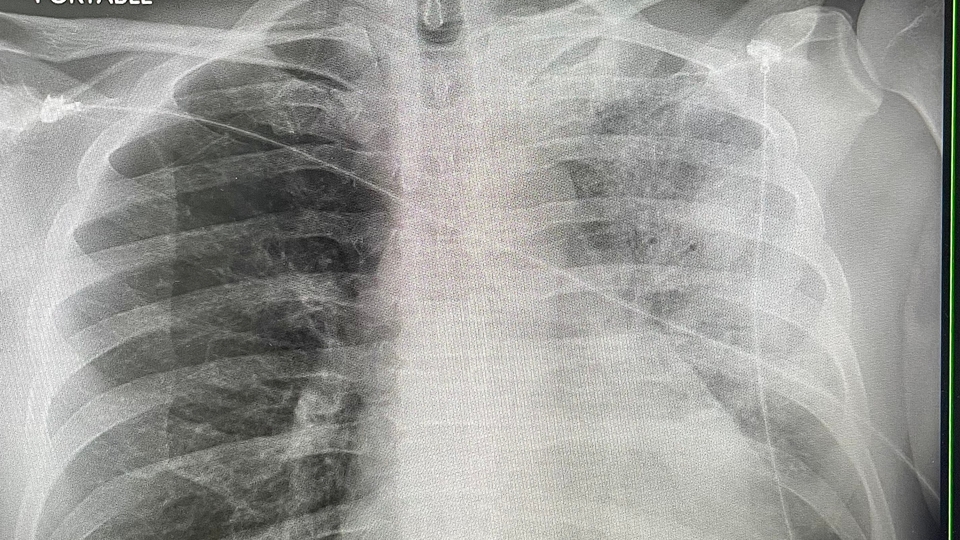 Klima hastalığına dikkat! Gecikmek ölüm getiriyor