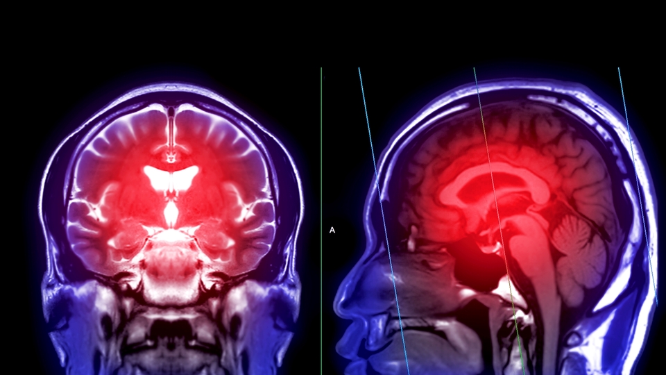 Beyne pıhtı atmadan önce vücut hangi sinyalleri veriyor?
