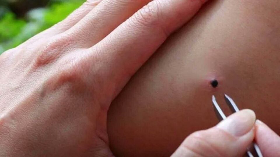 Tokat'ta KKKA hastalığı: 3 kişi tedavi görüyor