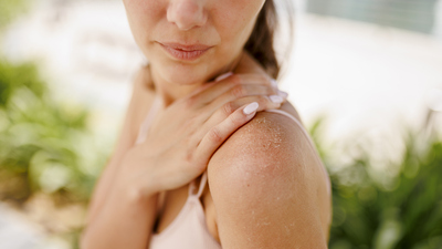 Güneş lekeleriyle vedalaşmanın yolları