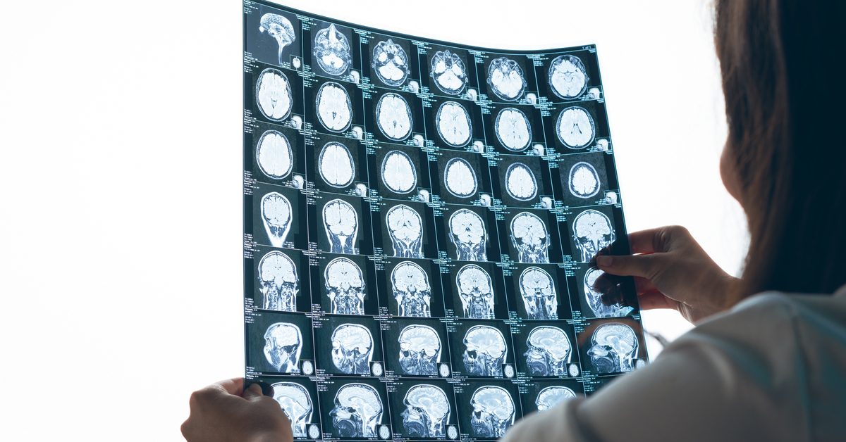 COVID-19 and Brain Aging: Research News