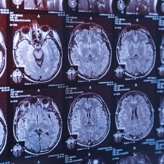 Alzheimer tanısında çığır açan gelişme