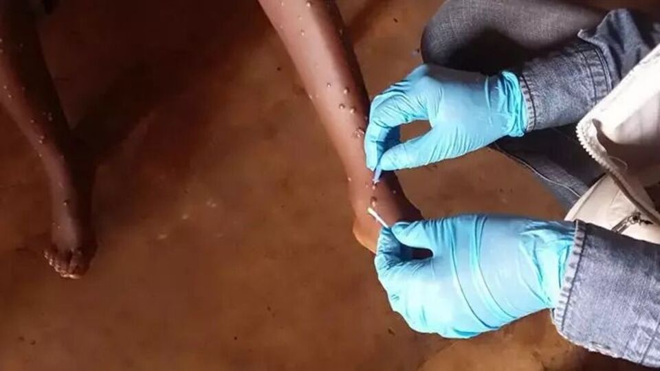 Gana'da M-çiçeği vaka sayısı 302'ye yükseldi