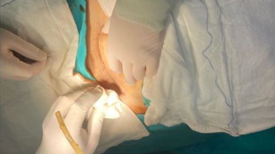 Karnında dren hortumu unutuldu!