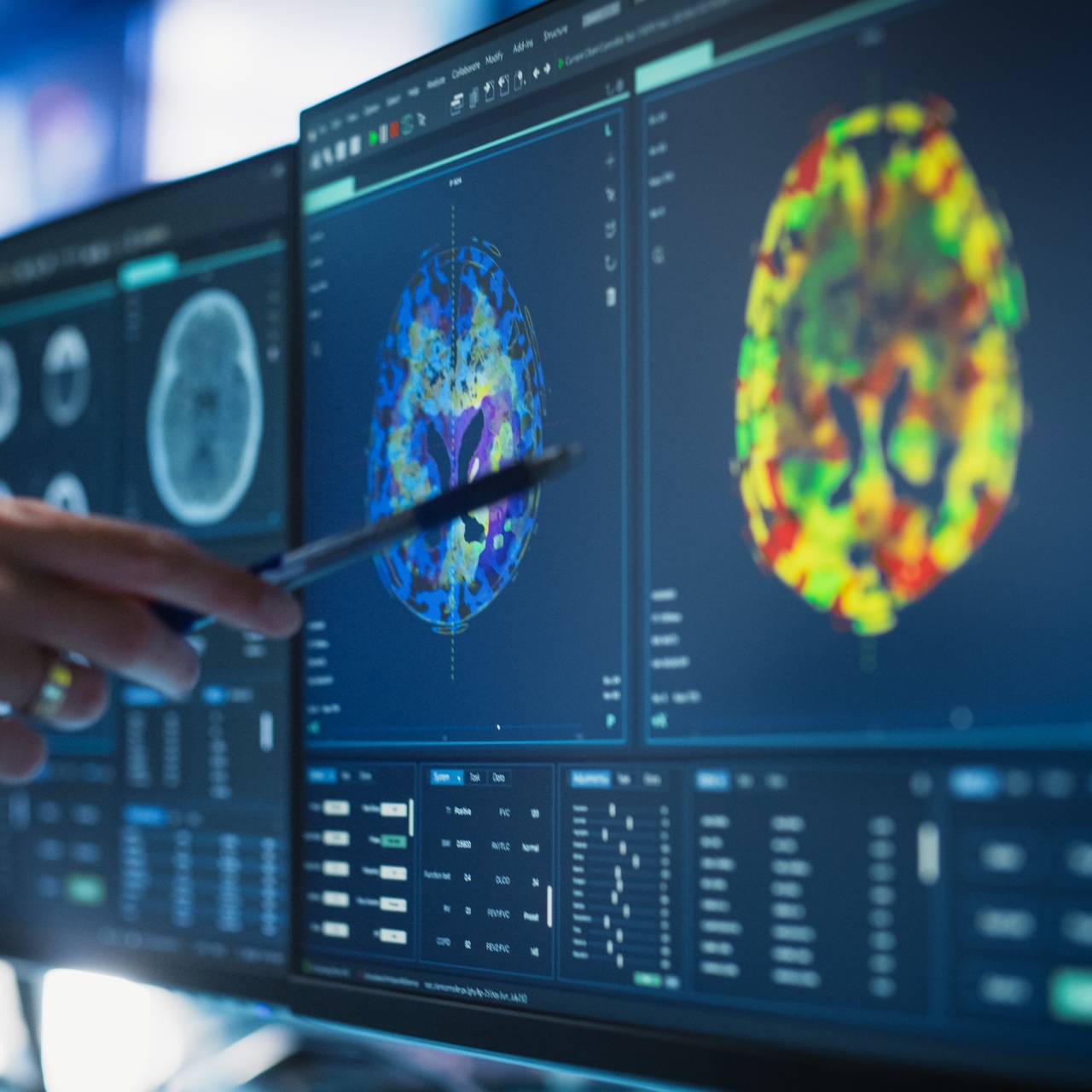 Alzheimer tedavisinde 'lityum' umudu