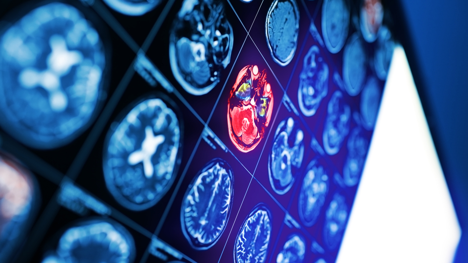 "Gençlerde beyin kanaması görülme oranı artıyor"