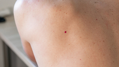 Ciltteki kırmızı benleri hafife almayın!