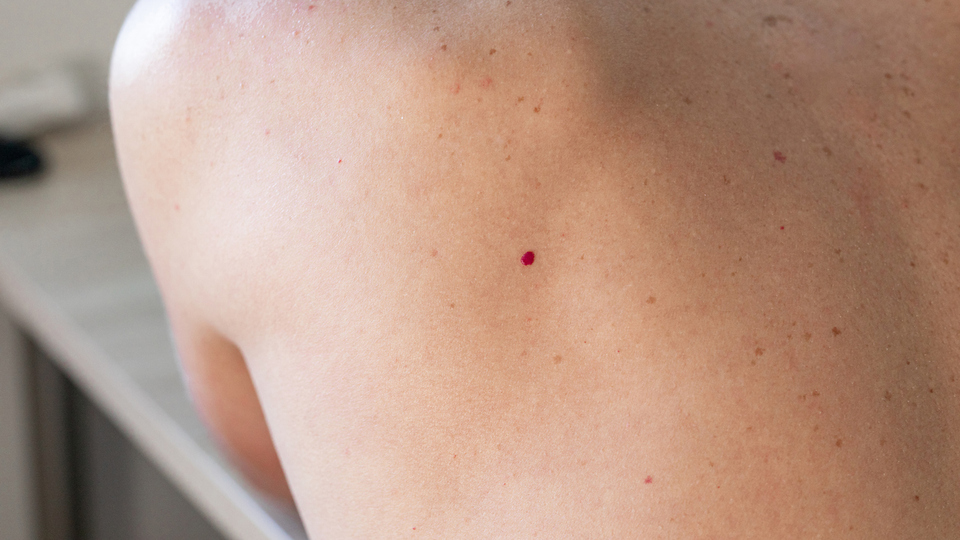 Ciltteki kırmızı benleri hafife almayın!