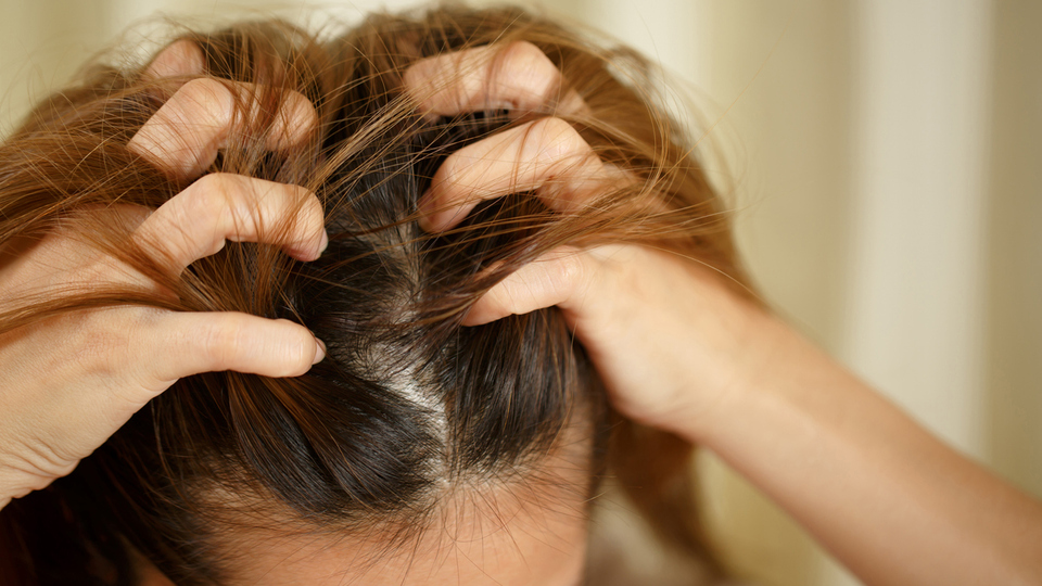 Saç derisinde kaşıntı doğal yoldan nasıl geçer?