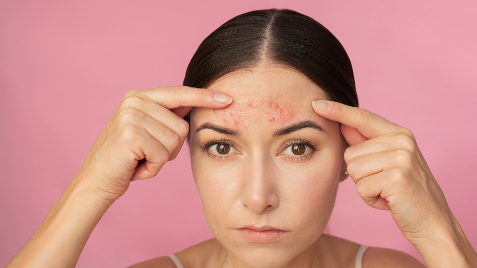 Aknenin asıl nedenleri sanıldığı gibi değil