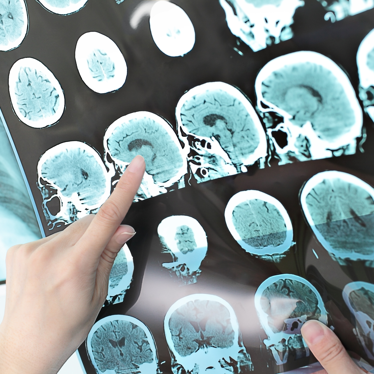 Her unutkanlık Alzheimer'a mı işaret?