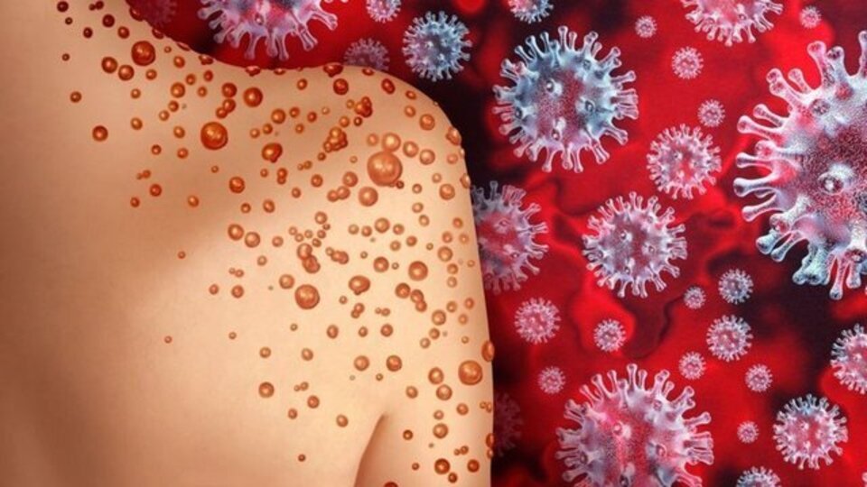 Gana'da maymun çiçeği virüsü vaka sayısı 583'e yükseldi