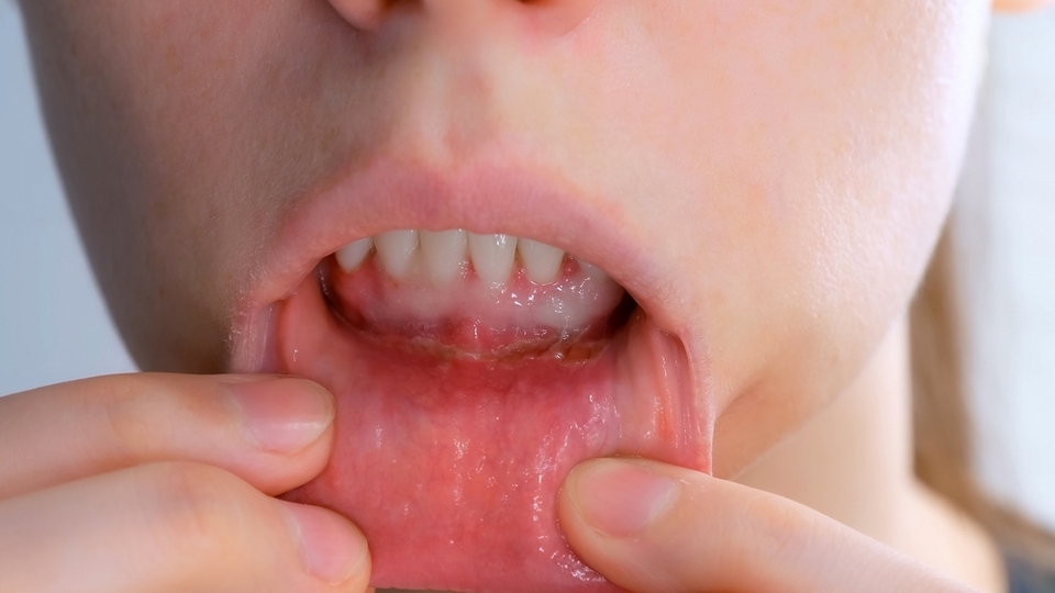 Ağız yaralarına karşı en güçlü doğal tedaviler