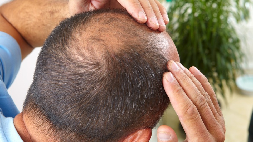 Saç dökülmesine bu yöntemlerle dur deyin!