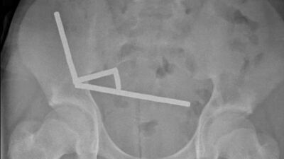 100 tane mıknatıs yuttu!