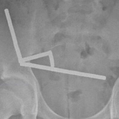 100 tane mıknatıs yuttu!